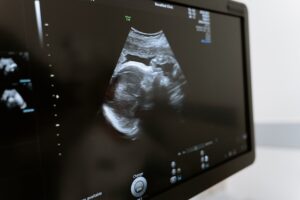 Understanding Doppler Ultrasound: What It Is and When You Might Need It